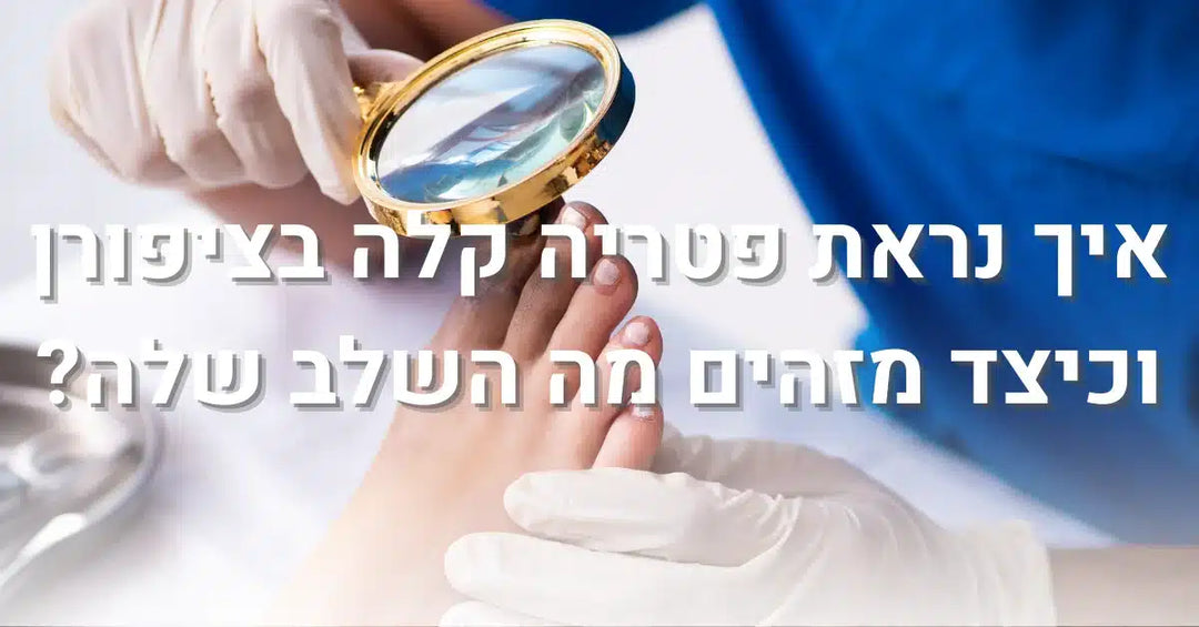 איך נראת פטריה קלה בציפורן וכיצד מזהים מה השלב שלה?